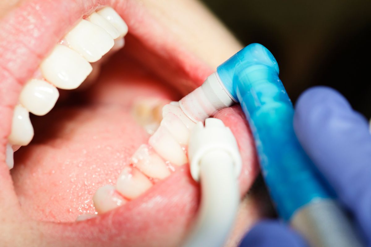 curetaje dental en Hermosillo