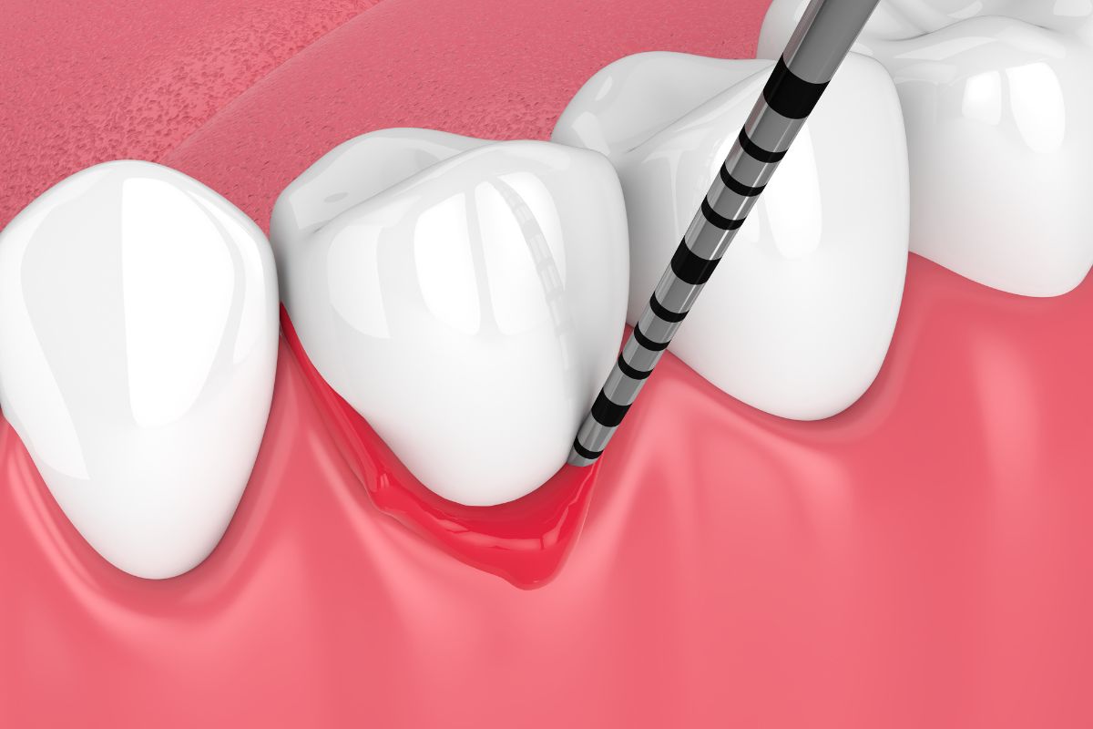 Especialista en periodontitis en Hermosillo