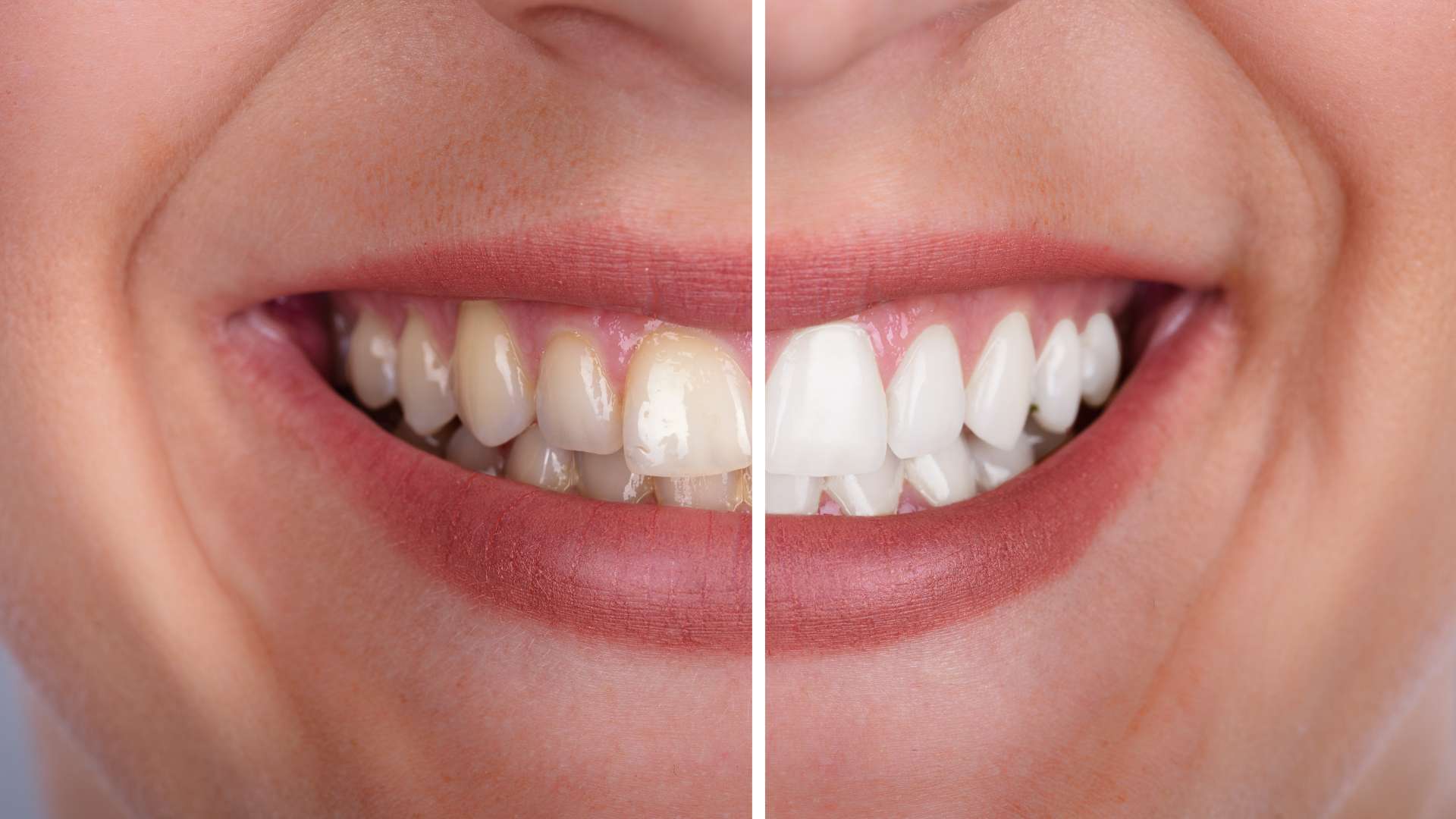 Tratamiento de manchas en los dientes en Hermosillo